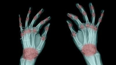 aa amyloidosis , aa amyloidosis treatment, aa amyloidosis symptoms, aa amyloidosis full form, aa amyloidosis causes, aa amyloidosis life expectancy, aa amyloidosis vs al amyloidosis, aa amyloidosis diagnosis, is aa amyloidosis terminal, amyloidosis symptoms, amyloidosis treatments, is amyloidosis cancer, amyloidosis causes, when to suspect amyloidosis, what are the 3 types of amyloidosis, amyloidosis diagnosis, amyloidosis types,