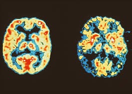 dementia diagnosis , dementia diagnosis timeline, early onset dementia diagnosis, frontotemporal dementia delay, dementia diagnostic barriers, dementia symptoms vs aging how long to diagnose dementia after symptoms, why is dementia hard to diagnose, average time to diagnose FTD, dementia misdiagnosis rates, early dementia symptoms checklist, dementia specialist referral criteria