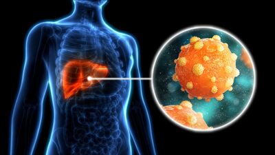 Hepatitis , Hepatitis symptoms, Is hepatitis curable?, Hepatitis B vaccine, Hepatitis transmission, Hepatitis A vs B vs C, Hepatitis treatment, Chronic hepatitis, Hepatitis and liver cancer, Hepatitis prevention, Hepatitis blood test,