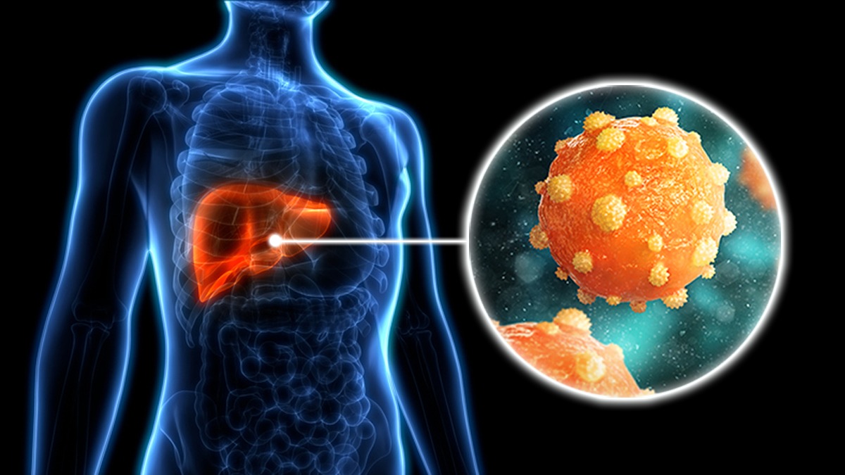 Hepatitis , Hepatitis symptoms, Is hepatitis curable?, Hepatitis B vaccine, Hepatitis transmission, Hepatitis A vs B vs C, Hepatitis treatment, Chronic hepatitis, Hepatitis and liver cancer, Hepatitis prevention, Hepatitis blood test,
