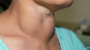 thyroid, thyroid tablets, thyroid symptoms in female, causes of thyroid in female, thyroid test, thyroid treatment, 19 signs of thyroid problems, thyroid gland, thyroid symptoms in male,