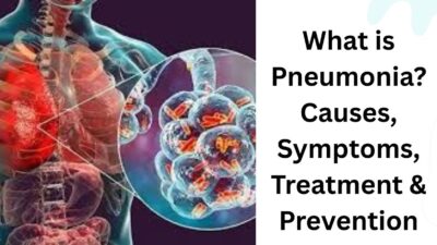 pneumonia , pneumonia symptoms, pneumonia treatment, is pneumonia contagious, pneumonia causes, is pneumonia deadly, types of pneumonia, signs that pneumonia is improving, is pneumonia contagious after antibiotics,