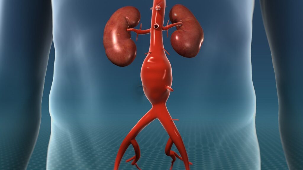 Abdominal Aortic Aneurysm