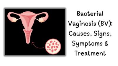 Bacterial vaginosis, BV symptoms, BV treatment, BV vs yeast infection, Fishy odor discharge, How to cure BV fast Recurrent BV,, BV during pregnancy, Is BV contagious?, Best BV antibiotics Natural BV remedies,, Can men get BV?, BV prevention tips, Does BV go away on its own?,BV and STDs,