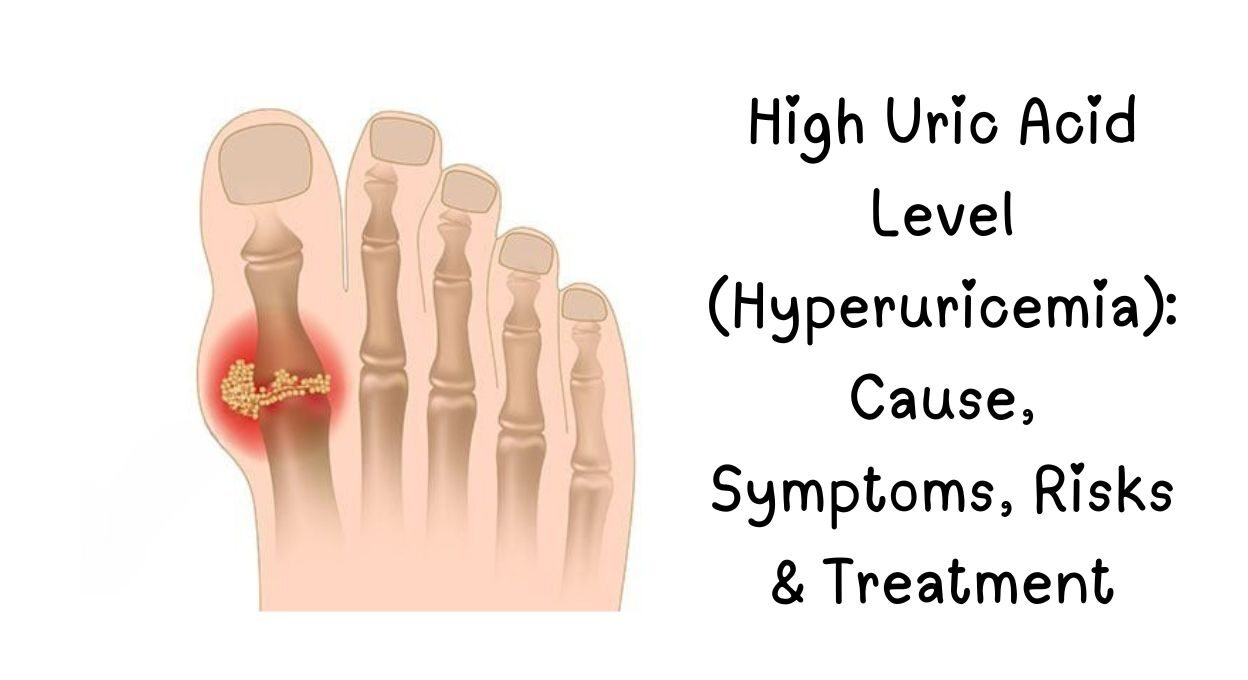 Uric acid, High uric acid symptoms, How to lower uric acid, Gout diet, Uric acid normal range, Best foods for uric acid, Does lemon water reduce uric acid, Uric acid and kidney stones, Uric acid treatment What causes high uric acid,