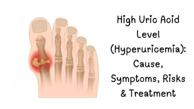 Uric acid, High uric acid symptoms, How to lower uric acid, Gout diet, Uric acid normal range, Best foods for uric acid, Does lemon water reduce uric acid, Uric acid and kidney stones, Uric acid treatment What causes high uric acid,