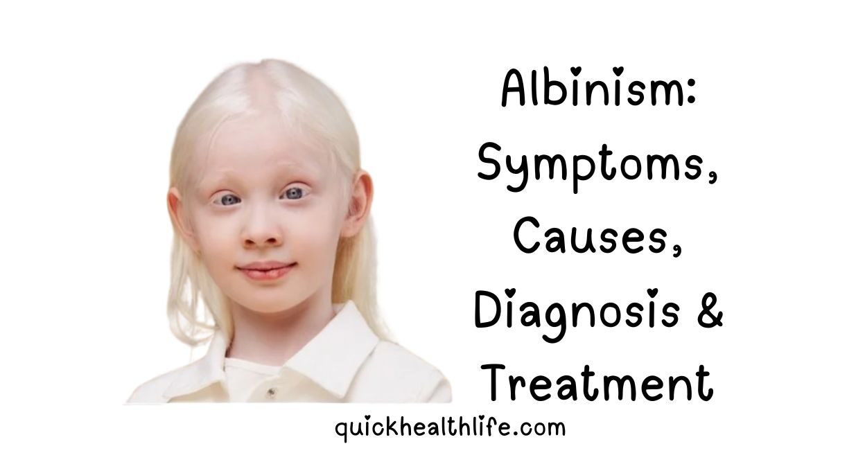 albinism, albinism symptoms, albinism types, ocular albinism, oculocutaneous albinism, albinism inheritance, albinism treatment, albinism causes, albinism diagnosis, albinism eyes, albinism vision problems, albinism skin care, albinism genetic condition, Hermansky-Pudlak syndrome, Chediak-Higashi syndrome, albinism management, albinism support, albinism in humans, albinism prevalence, albinism myths, albinism facts, albinism genetics, albinism melanin, albinism sun protection, albinism visual aids, albinism nystagmus, albinism photophobia, albinism strabismus, albinism low vision,