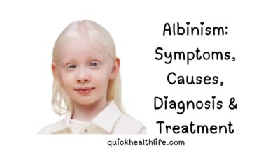 albinism, albinism symptoms, albinism types, ocular albinism, oculocutaneous albinism, albinism inheritance, albinism treatment, albinism causes, albinism diagnosis, albinism eyes, albinism vision problems, albinism skin care, albinism genetic condition, Hermansky-Pudlak syndrome, Chediak-Higashi syndrome, albinism management, albinism support, albinism in humans, albinism prevalence, albinism myths, albinism facts, albinism genetics, albinism melanin, albinism sun protection, albinism visual aids, albinism nystagmus, albinism photophobia, albinism strabismus, albinism low vision,
