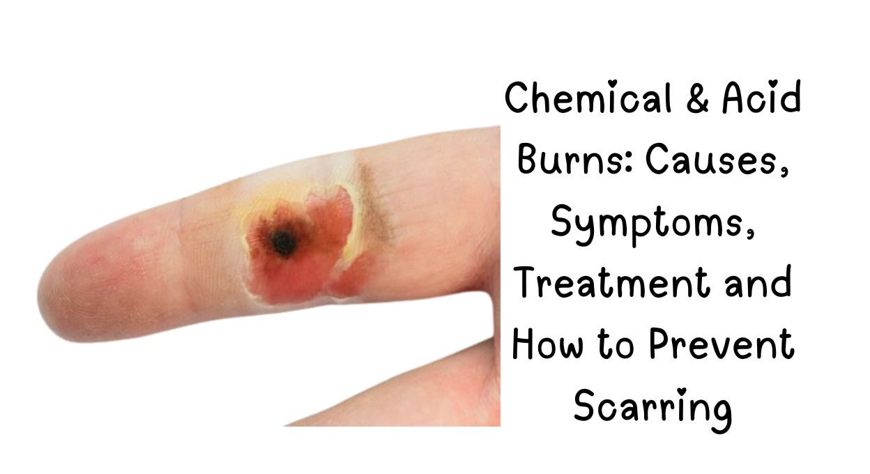 Chemical , Chemical burn treatment, Types of Chemical Burns, Chemical Burn Symptoms, Best Chemical Burn Treatment Creams, Acid burn first aid, How to treat chemical burns, Chemical burn symptoms, Alkali burn vs acid burn, Chemical burn on face, Best cream for chemical burns, Chemical burn healing time, How to prevent burn scars, Chemical burn neutralization,