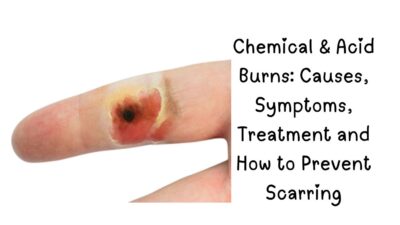 Chemical , Chemical burn treatment, Types of Chemical Burns, Chemical Burn Symptoms, Best Chemical Burn Treatment Creams, Acid burn first aid, How to treat chemical burns, Chemical burn symptoms, Alkali burn vs acid burn, Chemical burn on face, Best cream for chemical burns, Chemical burn healing time, How to prevent burn scars, Chemical burn neutralization,