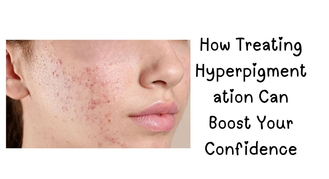 Hyperpigmentation