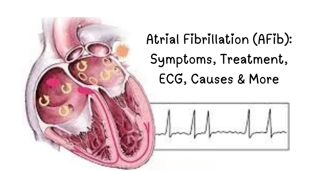 atrial fibrillation ,atrial fibrillation treatment, atrial fibrillation symptoms, atrial fibrillation ecg, what is the main cause of atrial fibrillation, atrial flutter, atrial fibrillation life expectancy, atrial fibrillation icd-10, can atrial fibrillation be cured, What is the atrial fibrillation?, What is the biggest trigger for atrial fibrillation?, Can you live normally with atrial fibrillation?,