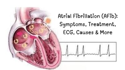atrial fibrillation ,atrial fibrillation treatment, atrial fibrillation symptoms, atrial fibrillation ecg, what is the main cause of atrial fibrillation, atrial flutter, atrial fibrillation life expectancy, atrial fibrillation icd-10, can atrial fibrillation be cured, What is the atrial fibrillation?, What is the biggest trigger for atrial fibrillation?, Can you live normally with atrial fibrillation?,