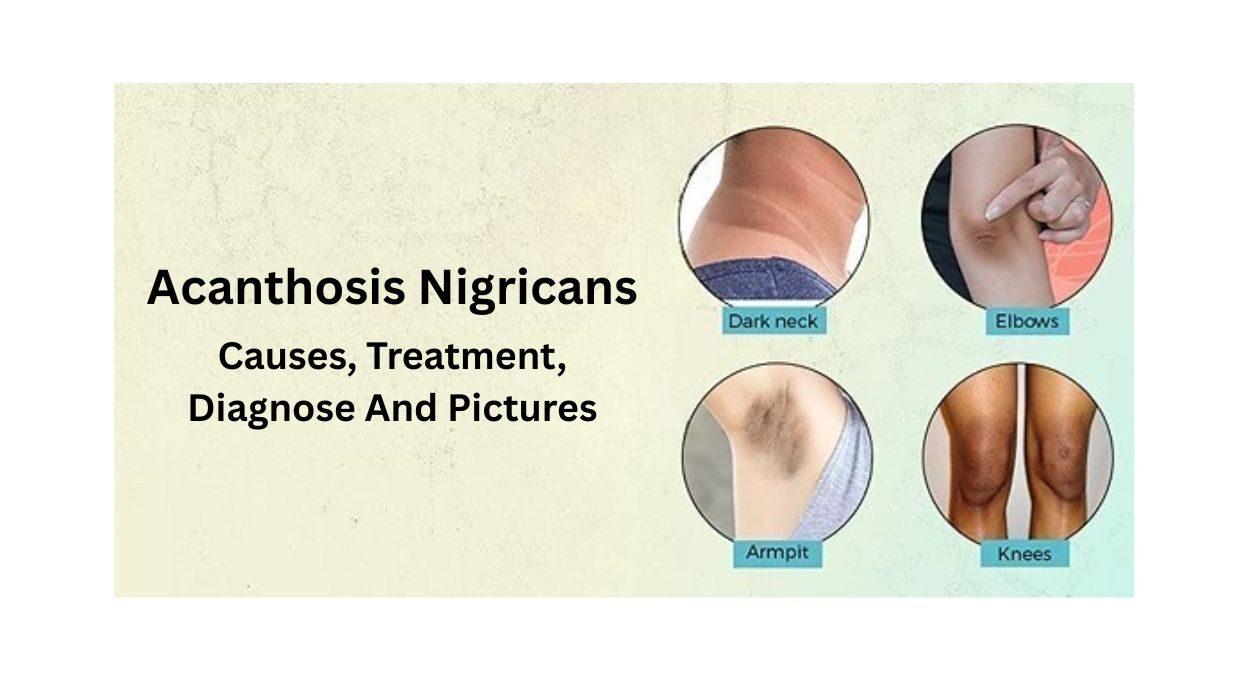 Acanthosis nigricans, Acanthosis nigricans treatment, Acanthosis nigricans causes, Dark neck diabetes, Acanthosis nigricans neck, How to get rid of acanthosis nigricans, Acanthosis nigricans cream, Acanthosis nigricans pictures, Acanthosis nigricans and diabetes, Insulin resistance dark skin, Acanthosis nigricans vs. regular dark skin, How to pronounce acanthosis nigricans,
