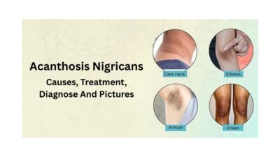 Acanthosis nigricans, Acanthosis nigricans treatment, Acanthosis nigricans causes, Dark neck diabetes, Acanthosis nigricans neck, How to get rid of acanthosis nigricans, Acanthosis nigricans cream, Acanthosis nigricans pictures, Acanthosis nigricans and diabetes, Insulin resistance dark skin, Acanthosis nigricans vs. regular dark skin, How to pronounce acanthosis nigricans,