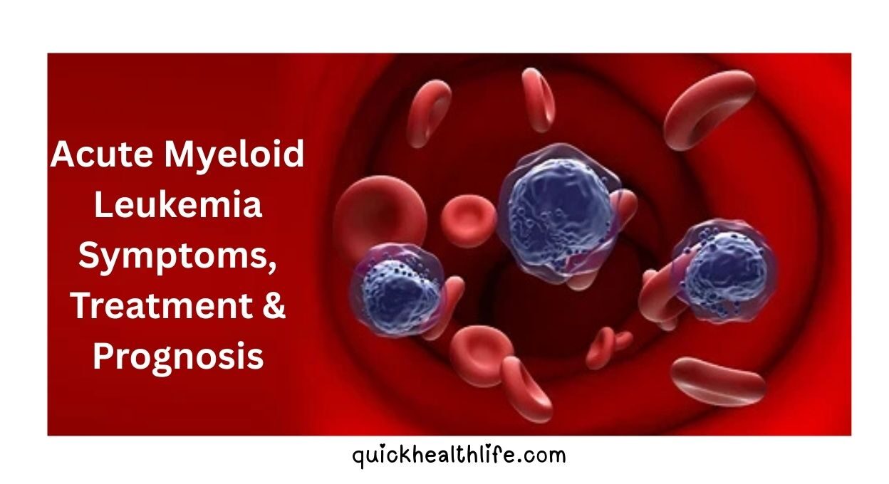 acute myeloid leukemia, acute myeloid leukemia survival rate, acute myeloid leukemia symptoms, acute myeloid leukemia prognosis, acute myeloid leukemia treatment, acute myeloid leukemia causes, acute myeloid leukemia stages, how do you die from acute myeloid leukemia, final stages of acute myeloid leukemia,