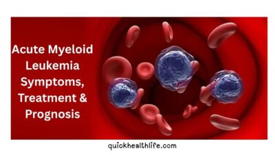 acute myeloid leukemia, acute myeloid leukemia survival rate, acute myeloid leukemia symptoms, acute myeloid leukemia prognosis, acute myeloid leukemia treatment, acute myeloid leukemia causes, acute myeloid leukemia stages, how do you die from acute myeloid leukemia, final stages of acute myeloid leukemia,