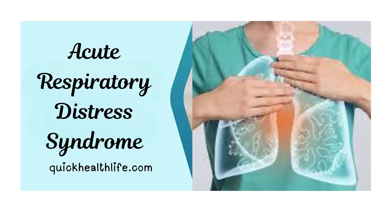 acute respiratory distress syndrome, acute respiratory distress syndrome symptoms, acute respiratory distress syndrome treatment, acute respiratory distress syndrome causes, acute respiratory distress syndrome pathophysiology, acute respiratory distress syndrome ppt, acute respiratory distress syndrome icd-10, ards survival rate by age, 4 stages of ards, ards management, ards diagnosis, ards prognosis, ards prevention, ards complications, ards rehabilitation, ards outlook