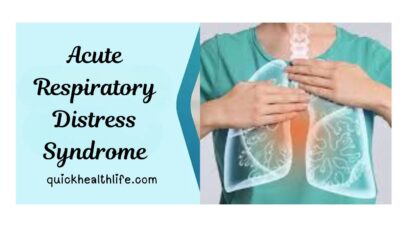 acute respiratory distress syndrome, acute respiratory distress syndrome symptoms, acute respiratory distress syndrome treatment, acute respiratory distress syndrome causes, acute respiratory distress syndrome pathophysiology, acute respiratory distress syndrome ppt, acute respiratory distress syndrome icd-10, ards survival rate by age, 4 stages of ards, ards management, ards diagnosis, ards prognosis, ards prevention, ards complications, ards rehabilitation, ards outlook