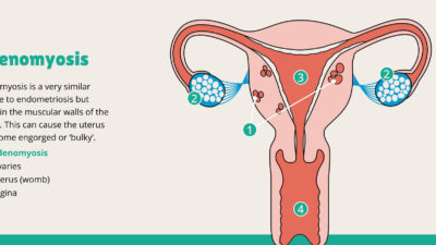 Adenomyosis