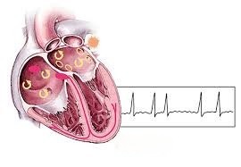 atrial fibrillation ,atrial fibrillation treatment,
atrial fibrillation symptoms,
atrial fibrillation ecg,
what is the main cause of atrial fibrillation,
atrial flutter,
atrial fibrillation life expectancy,
atrial fibrillation icd-10,
can atrial fibrillation be cured,
What is the atrial fibrillation?,
What is the biggest trigger for atrial fibrillation?,
Can you live normally with atrial fibrillation?,
