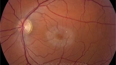 MacTel, ENCELTO implant, MacTel treatment, macular telangiectasia type 2, revakinagene taroretcel-lwey, CNTF for vision loss, FDA-approved MacTel therapy, neuroprotective retinal implant, ENCELTO clinical trials, slow vision loss, retinal degeneration treatment, , ENCELTO implant, MacTel treatment, macular telangiectasia type 2, revakinagene taroretcel-lwey, CNTF for vision loss, FDA-approved MacTel therapy, neuroprotective retinal implant, ENCELTO clinical trials, slow vision loss, retinal degeneration treatment,