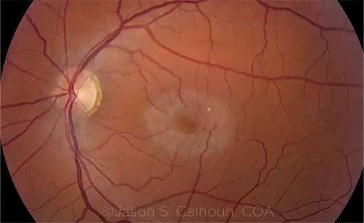 MacTel, ENCELTO implant, MacTel treatment, macular telangiectasia type 2, revakinagene taroretcel-lwey, CNTF for vision loss, FDA-approved MacTel therapy, neuroprotective retinal implant, ENCELTO clinical trials, slow vision loss, retinal degeneration treatment, , ENCELTO implant, MacTel treatment, macular telangiectasia type 2, revakinagene taroretcel-lwey, CNTF for vision loss, FDA-approved MacTel therapy, neuroprotective retinal implant, ENCELTO clinical trials, slow vision loss, retinal degeneration treatment,