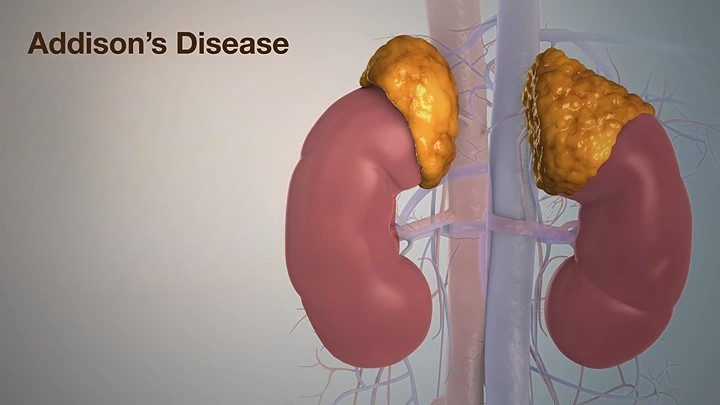 Addison's disease, Addison's disease symptoms, Addison's disease causes, Addison's disease treatments, Addison's disease diagnosis, Addison's disease blood test results, how to test for Addison's disease, what causes Addison's disease, Addison's disease in dogs, Addison's disease dog, Addison's disease medication, Addison's disease crisis, Addison's disease cure, how I cured my Addison's disease, Addison's disease natural treatment, Addison's disease early signs, Addison's disease prevention, Addison's disease management, Addison's disease complications, Addison's disease autoimmune, Addison's disease rare condition, Addison's disease and cortisol, Addison's disease hormone replacement,