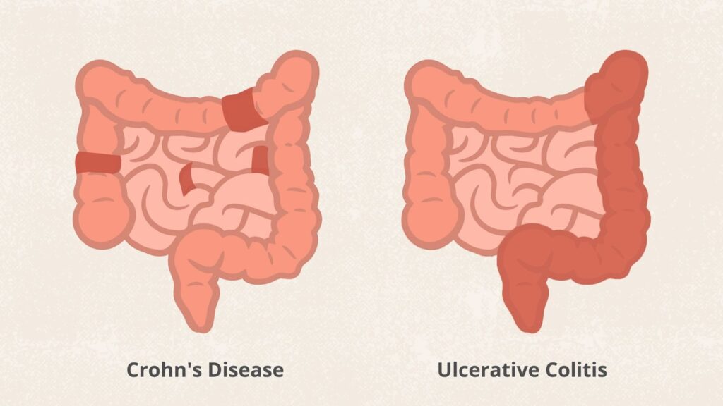 Ulcerative Colitis, Crohn's Disease, Inflammatory Bowel Disease (IBD), IBD symptoms, UC diet, Crohn's diet, IBD treatment, IBD flare, IBD remission, colitis treatment, Crohn's treatment, ulcerative colitis vs crohn's, IBD causes, IBD diagnosis, biologics for IBD, JAK inhibitors, colectomy, IBD complications, probiotics for IBD, Mediterranean diet IBD, processed food IBD