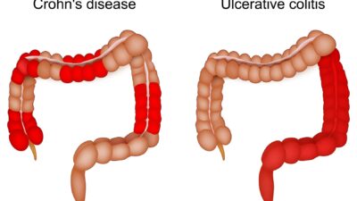 Ulcerative Colitis, Crohn's Disease, Inflammatory Bowel Disease (IBD), IBD symptoms, UC diet, Crohn's diet, IBD treatment, IBD flare, IBD remission, colitis treatment, Crohn's treatment, ulcerative colitis vs crohn's, IBD causes, IBD diagnosis, biologics for IBD, JAK inhibitors, colectomy, IBD complications, probiotics for IBD, Mediterranean diet IBD, processed food IBD