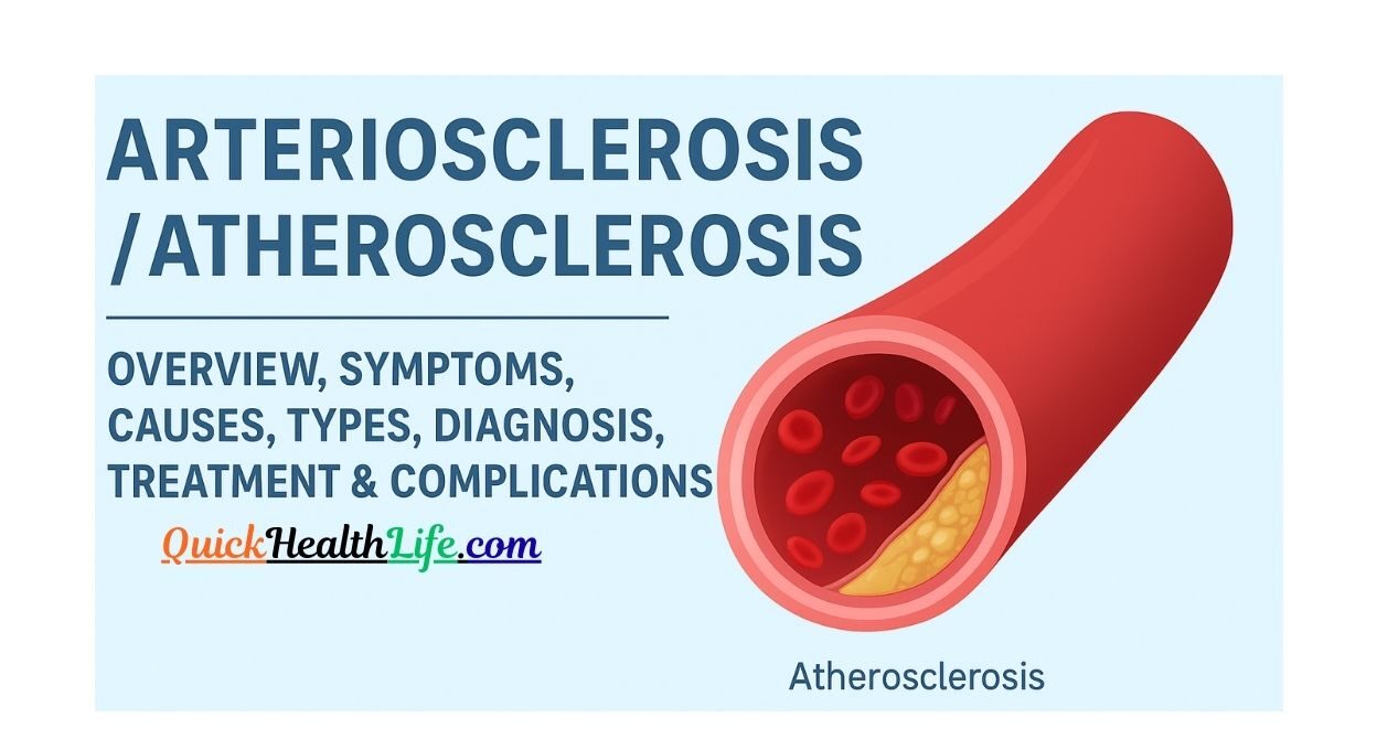 atherosclerosis, atherosclerosis vs arteriosclerosis, atherosclerosis treatment, atherosclerosis symptoms, causes of atherosclerosis, atherosclerosis ppt, atherosclerosis pathophysiology, atherosclerosis diagnosis, atherosclerosis stages, What is the atherosclerosis?, Is atherosclerosis treatable?, What are 5 symptoms of atherosclerosis?, Is atherosclerosis is reversible? ,