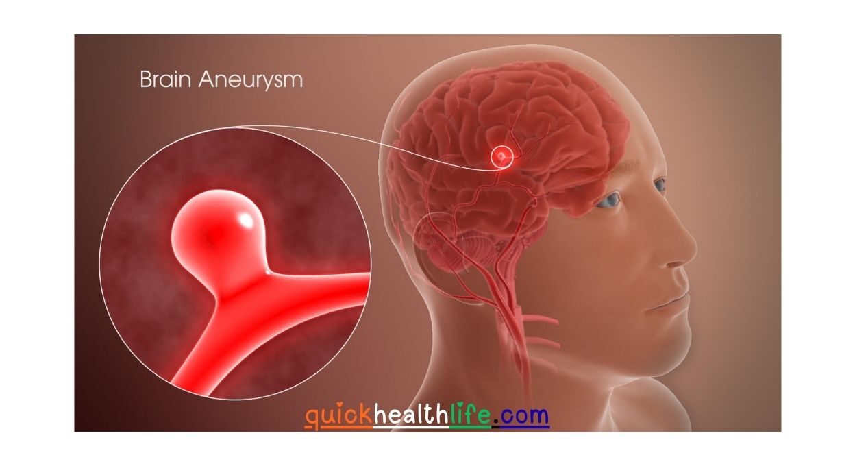 brain aneurysm, brain aneurysm symptoms, brain aneurysm causes, how to diagnose brain aneurysm, brain aneurysm treatment and surgery, brain aneurysm vs stroke, complications of brain aneurysm rupture, can you survive a brain aneurysm, brain aneurysm prevention tips,