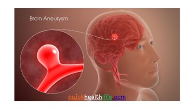 brain aneurysm, brain aneurysm symptoms, brain aneurysm causes, how to diagnose brain aneurysm, brain aneurysm treatment and surgery, brain aneurysm vs stroke, complications of brain aneurysm rupture, can you survive a brain aneurysm, brain aneurysm prevention tips,