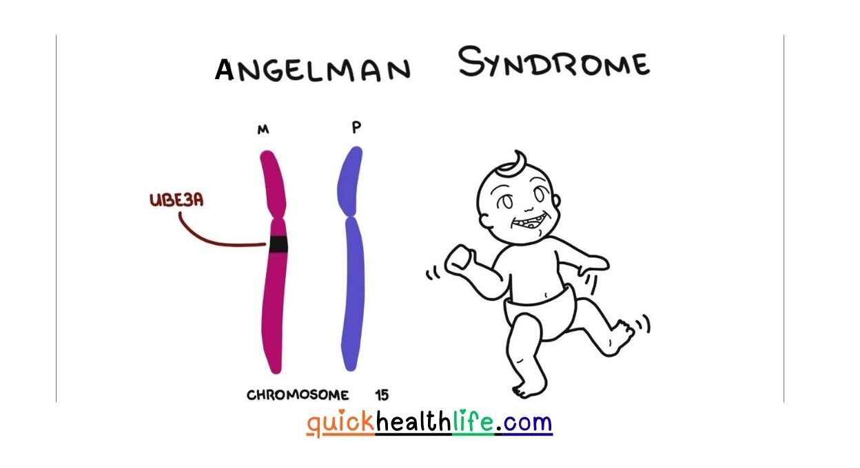 Angelman Syndrome, Angelman Syndrome symptoms and causes, Angelman Syndrome treatment options, Angelman Syndrome vs autism vs Prader-Willi, Angelman Syndrome inheritance and genetics, Angelman Syndrome diagnosis tests, Angelman Syndrome life expectancy, Angelman Syndrome research and gene therapy, ICD-10 code for Angelman Syndrome