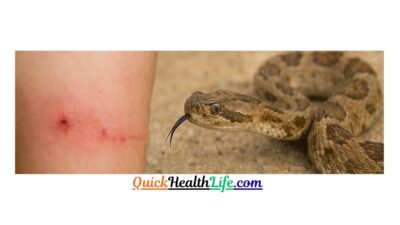 snake bite, snake bite first aid, venomous snakes, snake bite symptoms, snake bite treatment, rattlesnake bite, antivenom, snake identification, snake bite prevention, emergency snake bite, poisonous snakes, snake bite care, snake bite signs, copperhead bite, cobra bite, viper bite, snake bite emergency, snake bite protocol, snake bite do's and don'ts, snake bite recovery