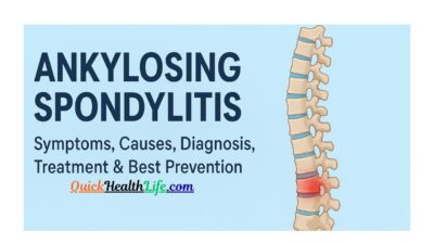 ankylosing spondylitis, ankylosing spondylitis medication, ankylosing spondylitis treatment, ankylosing spondylitis symptoms, ankylosing spondylitis diagnosis, ankylosing spondylitis symptoms females, how i cured my ankylosing spondylitis,, ankylosing spondylitis test, ankylosing spondylitis icd-10, Can ankylosing spondylitis be cured?, What is Stage 1 ankylosing spondylitis?, What is the life expectancy of someone with ankylosing spondylitis?, Is HLA-B27 positive life threatening?