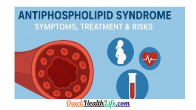 antiphospholipid syndrome, antiphospholipid syndrome in pregnancy, antiphospholipid syndrome treatment, antiphospholipid syndrome in pregnancy criteria, antiphospholipid syndrome symptoms, antiphospholipid syndrome antibodies, antiphospholipid syndrome rash pictures, antiphospholipid syndrome test, can antiphospholipid syndrome cause weight gain, How do you diagnose antiphospholipid syndrome?,