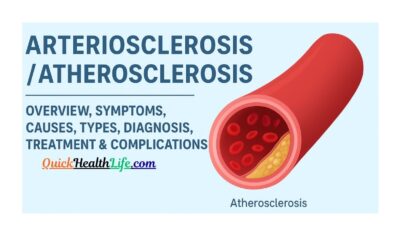 atherosclerosis, atherosclerosis vs arteriosclerosis, atherosclerosis treatment, atherosclerosis symptoms, causes of atherosclerosis, atherosclerosis ppt, atherosclerosis pathophysiology, atherosclerosis diagnosis, atherosclerosis stages, What is the atherosclerosis?, Is atherosclerosis treatable?, What are 5 symptoms of atherosclerosis?, Is atherosclerosis is reversible? ,