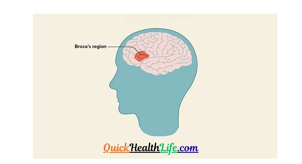 Aphasia