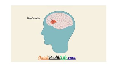 Aphasia