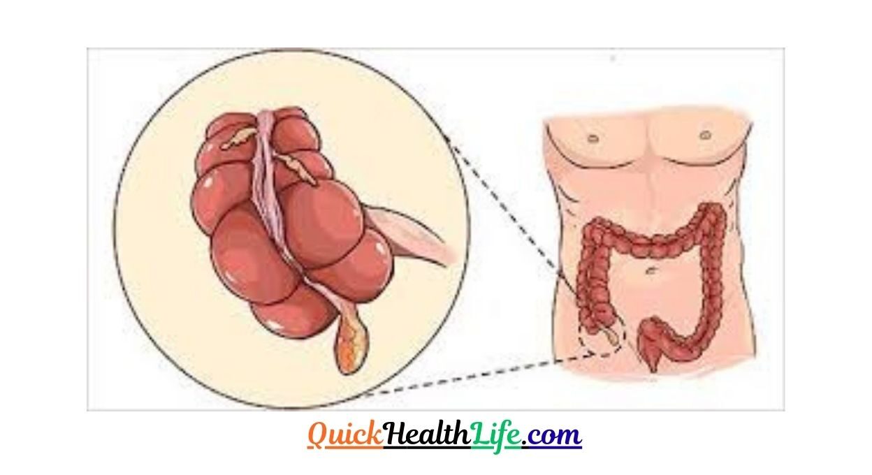 appendicitis , appendicitis symptoms, 4 stages of appendicitis, appendicitis causes, appendicitis treatment, appendicitis surgery, appendix symptoms in female, how to check for appendicitis at home, appendicitis test, What causes appendicitis?, What is appendicitis pain like?, How do you treat appendicitis?, Can you cure appendicitis without surgery?,