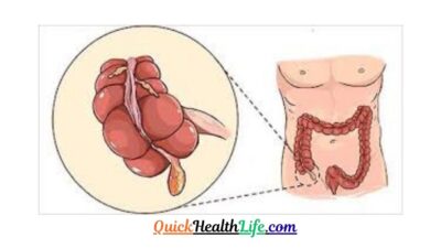 appendicitis , appendicitis symptoms, 4 stages of appendicitis, appendicitis causes, appendicitis treatment, appendicitis surgery, appendix symptoms in female, how to check for appendicitis at home, appendicitis test, What causes appendicitis?, What is appendicitis pain like?, How do you treat appendicitis?, Can you cure appendicitis without surgery?,