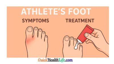 athletes foot, athletes foot cream, what kills athlete's foot instantly, athlete's foot treatment, is athlete's foot dangerous, how to cure athlete's foot in one day, types of athlete's foot pictures, is athlete's foot contagious, athlete's foot pictures blisters, What is the main cause of athlete's foot?, How do I cure my athlete's foot?, Is athlete's foot ringworm?, Does athlete's foot go away by itself?,