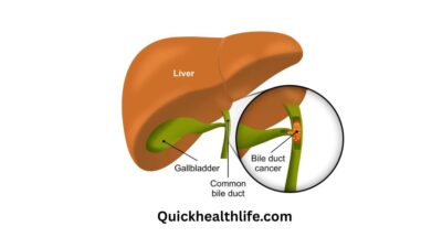 bile duct cancer, bile duct cancer symptoms, what happens in the final stages of bile duct cancer, bile duct cancer symptoms female, what is the survival rate of bile duct cancer, how fast does bile duct cancer spread, bile duct cancer causes, what is the number one cause of bile duct cancer, bile duct cancer treatment, What is the survival rate for bile duct cancer?, Is the bile duct cancer terminal?, What are symptoms of stage 4 bile duct cancer?,