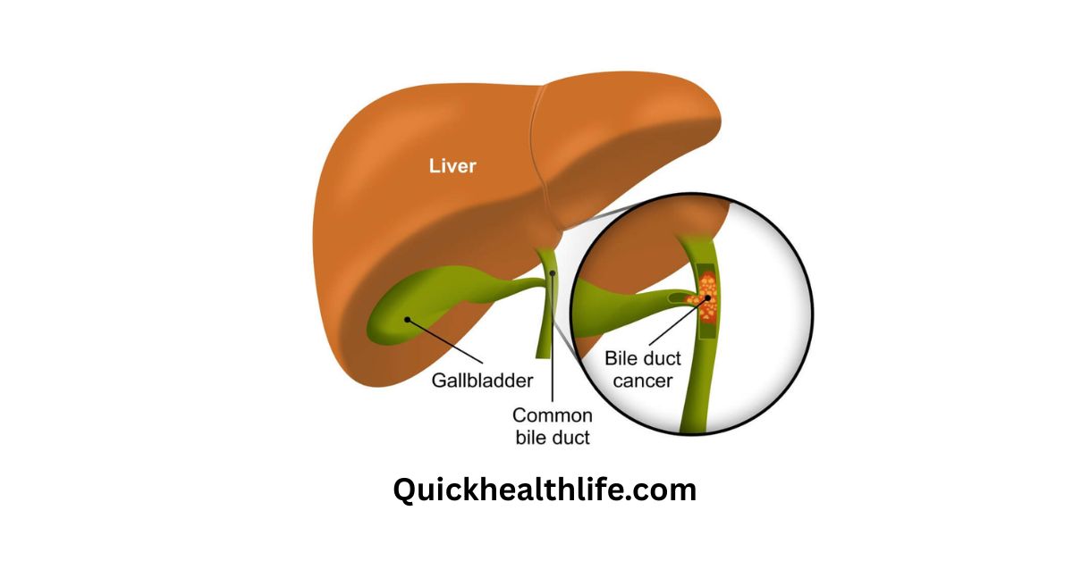 bile duct cancer, bile duct cancer symptoms, what happens in the final stages of bile duct cancer, bile duct cancer symptoms female, what is the survival rate of bile duct cancer, how fast does bile duct cancer spread, bile duct cancer causes, what is the number one cause of bile duct cancer, bile duct cancer treatment, What is the survival rate for bile duct cancer?, Is the bile duct cancer terminal?, What are symptoms of stage 4 bile duct cancer?,