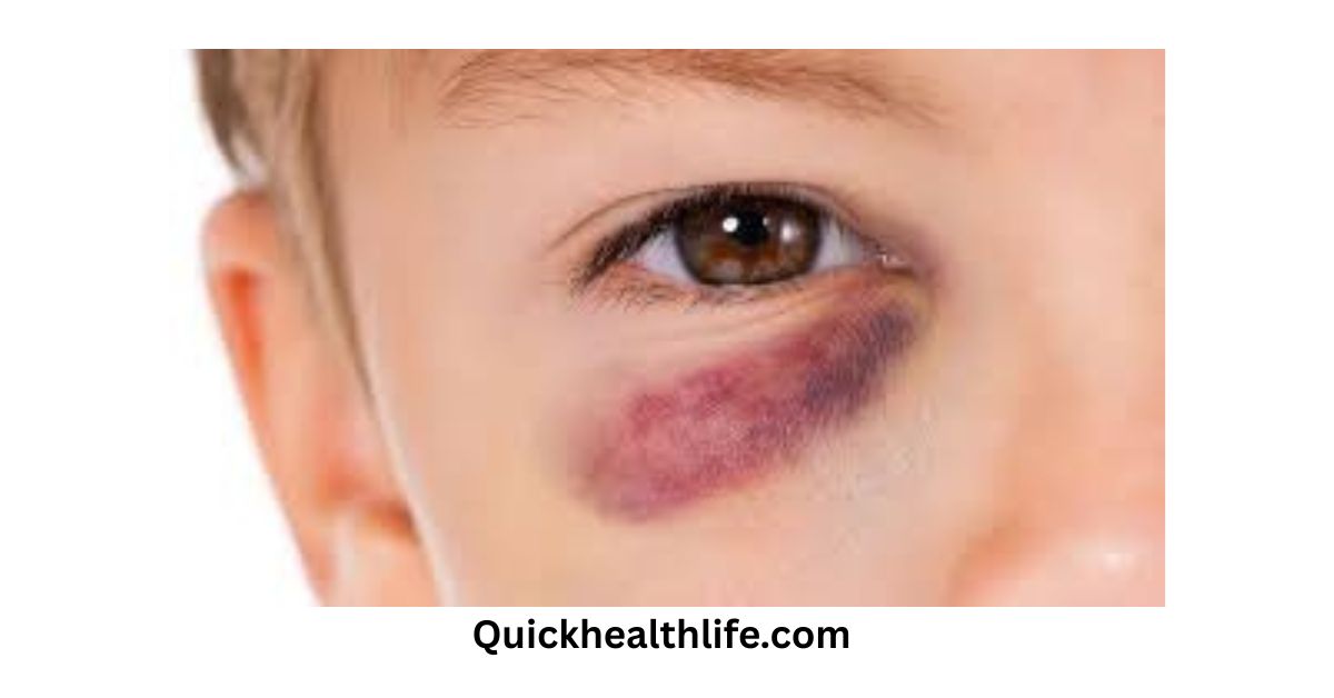 black eye,black eyes color , sudden black eye without injury, when to worry about a black eye,, black eye causes, how to get rid of a black eye in 30 minutes, black eye anatomy, black eyes natural, black eyes iris, How to heal a black eye faster?, How long do black eyes take to heal?, Why does black eye occur in scalp injury?, What is another name for a black eye?,