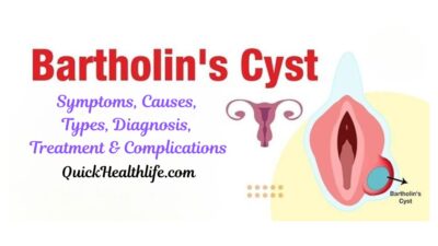 Bartholin’s cyst, Bartholin abscess, Bartholin’s cyst treatment, Bartholin cyst causes, Bartholin gland infection, Bartholin cyst symptoms, Bartholin cyst pictures, Bartholin cyst home remedies, Bartholin cyst antibiotics, vaginal cyst treatment