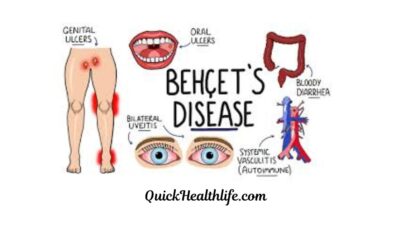 Behçet's disease, behçet's disease zero to finals, behçet's disease treatment, behçet's disease life expectancy, behcet's disease symptoms, behçet's disease diagnostic criteria, behcet's rash pictures, behçet's disease blood test, behçet's disease cause, Is Behcet's disease curable?, What causes a Behcet's flare-up?, What is the Behcet's disease triad?, What foods should you avoid with Behcet's disease?,