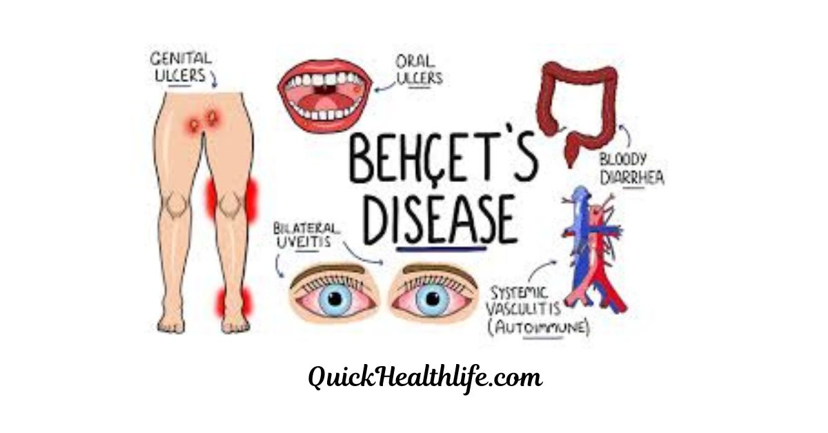Behçet's disease, behçet's disease zero to finals, behçet's disease treatment, behçet's disease life expectancy, behcet's disease symptoms, behçet's disease diagnostic criteria, behcet's rash pictures, behçet's disease blood test, behçet's disease cause, Is Behcet's disease curable?, What causes a Behcet's flare-up?, What is the Behcet's disease triad?, What foods should you avoid with Behcet's disease?,