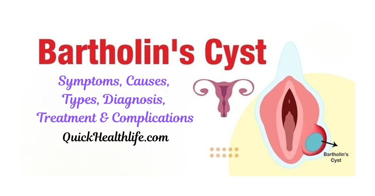 Bartholin’s cyst, Bartholin abscess, Bartholin’s cyst treatment, Bartholin cyst causes, Bartholin gland infection, Bartholin cyst symptoms, Bartholin cyst pictures, Bartholin cyst home remedies, Bartholin cyst antibiotics, vaginal cyst treatment